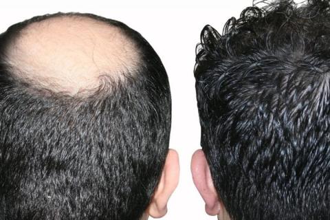 Saç ekimi güçlü saç köklerinin ince bir bölgeye veya boş bölgeye nakledilmesi işlemidir.